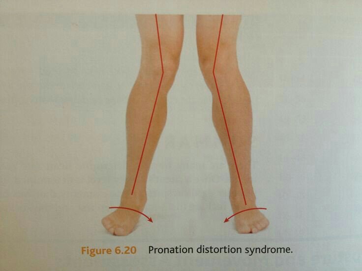 Illustration on howPronated feet causes pegeon toes
