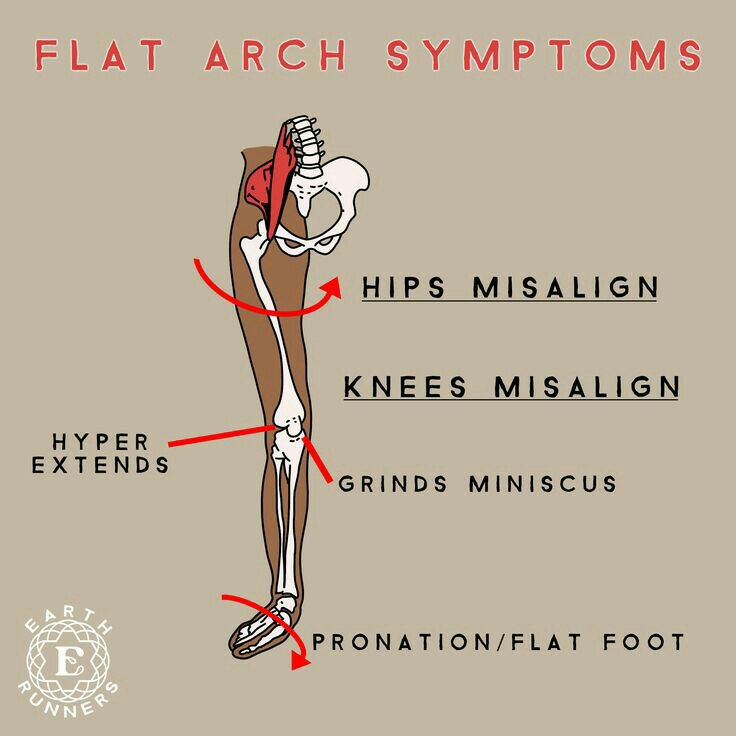Illustration of how a feet pronation affects the appearance of hip dips